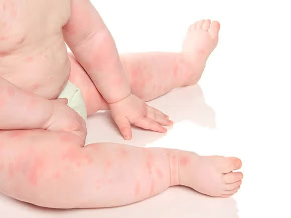¿Por qué le dan alergias a los bebés? Lo que toda mamá debe saber